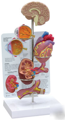 New brand hypertension model set model