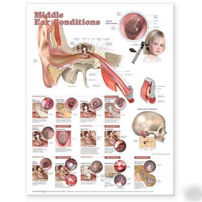 Middle ear conditions anatomical chart/charts/model