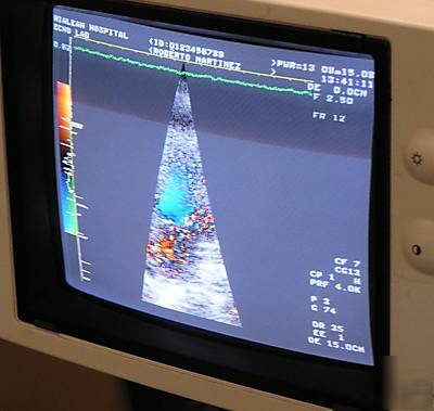 Toshiba sonolayer ssh-160 diagnostic ultrasound 