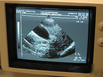 Toshiba sonolayer ssh-160 diagnostic ultrasound 